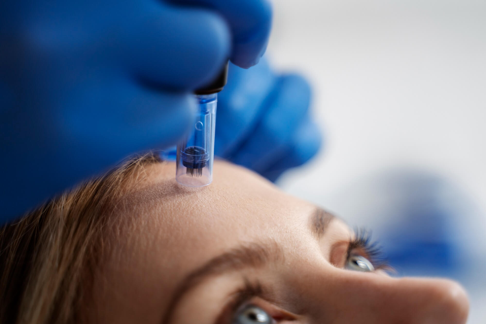 Cosmetic Microneedling